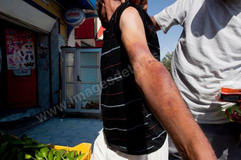 Homme blessé par agression et plombs de tirs de carabine lors des affrontements du 3 au 5 juin 2011 dans la ville de Metlaoui