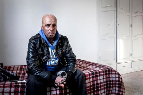 29 janvier 2016: Hosni Kaliya s'est immolé le 6 janvier 2011 après avroi été battu à deux reprises par des policiers de Kasserine. Cinq ans après, Hosni, brulé sur tout le corps doit vivre au quotidien avec des douleurs permanentes et le regard difficil de la société. Il vit actuellement dans un foyer social de l'Etat en attente d'être envoyé en Italie pour subir plusieurs interventions et poses de prothèses. Il y adeux mois son jeune frère s'est immolé à Kasserine et est décédé. l'immolation est devenu un phénoméne fréquent en Tunisie, en partie en mimétisme avec Mohamed Bouazizi, mais surtout comme un geste de desespoir d'une société et d'une jeunesse abandonnée (113 immolations en 2015).