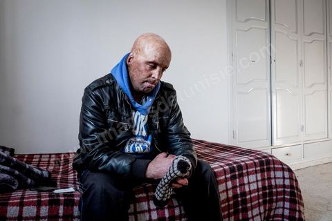29 janvier 2016: Hosni Kaliya s'est immolé le 6 janvier 2011 après avroi été battu à deux reprises par des policiers de Kasserine. Cinq ans après, Hosni, brulé sur tout le corps doit vivre au quotidien avec des douleurs permanentes et le regard difficil de la société. Il vit actuellement dans un foyer social de l'Etat en attente d'être envoyé en Italie pour subir plusieurs interventions et poses de prothèses. Il y adeux mois son jeune frère s'est immolé à Kasserine et est décédé. l'immolation est devenu un phénoméne fréquent en Tunisie, en partie en mimétisme avec Mohamed Bouazizi, mais surtout comme un geste de desespoir d'une société et d'une jeunesse abandonnée (113 immolations en 2015).