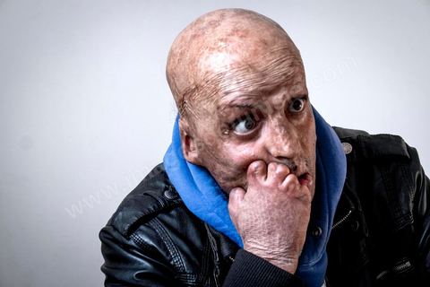 29 janvier 2016: Hosni Kaliya s'est immolé le 6 janvier 2011 après avroi été battu à deux reprises par des policiers de Kasserine. Cinq ans après, Hosni, brulé sur tout le corps doit vivre au quotidien avec des douleurs permanentes et le regard difficil de la société. Il vit actuellement dans un foyer social de l'Etat en attente d'être envoyé en Italie pour subir plusieurs interventions et poses de prothèses. Il y adeux mois son jeune frère s'est immolé à Kasserine et est décédé. l'immolation est devenu un phénoméne fréquent en Tunisie, en partie en mimétisme avec Mohamed Bouazizi, mais surtout comme un geste de desespoir d'une société et d'une jeunesse abandonnée (113 immolations en 2015).