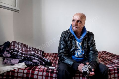 29 janvier 2016: Hosni Kaliya s'est immolé le 6 janvier 2011 après avroi été battu à deux reprises par des policiers de Kasserine. Cinq ans après, Hosni, brulé sur tout le corps doit vivre au quotidien avec des douleurs permanentes et le regard difficil de la société. Il vit actuellement dans un foyer social de l'Etat en attente d'être envoyé en Italie pour subir plusieurs interventions et poses de prothèses. Il y adeux mois son jeune frère s'est immolé à Kasserine et est décédé. l'immolation est devenu un phénoméne fréquent en Tunisie, en partie en mimétisme avec Mohamed Bouazizi, mais surtout comme un geste de desespoir d'une société et d'une jeunesse abandonnée (113 immolations en 2015).