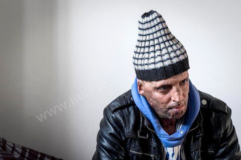 29 janvier 2016: Hosni Kaliya s'est immolé le 6 janvier 2011 après avroi été battu à deux reprises par des policiers de Kasserine. Cinq ans après, Hosni, brulé sur tout le corps doit vivre au quotidien avec des douleurs permanentes et le regard difficil de la société. Il vit actuellement dans un foyer social de l'Etat en attente d'être envoyé en Italie pour subir plusieurs interventions et poses de prothèses. Il y adeux mois son jeune frère s'est immolé à Kasserine et est décédé. l'immolation est devenu un phénoméne fréquent en Tunisie, en partie en mimétisme avec Mohamed Bouazizi, mais surtout comme un geste de desespoir d'une société et d'une jeunesse abandonnée (113 immolations en 2015).