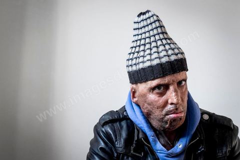 29 janvier 2016: Hosni Kaliya s'est immolé le 6 janvier 2011 après avroi été battu à deux reprises par des policiers de Kasserine. Cinq ans après, Hosni, brulé sur tout le corps doit vivre au quotidien avec des douleurs permanentes et le regard difficil de la société. Il vit actuellement dans un foyer social de l'Etat en attente d'être envoyé en Italie pour subir plusieurs interventions et poses de prothèses. Il y adeux mois son jeune frère s'est immolé à Kasserine et est décédé. l'immolation est devenu un phénoméne fréquent en Tunisie, en partie en mimétisme avec Mohamed Bouazizi, mais surtout comme un geste de desespoir d'une société et d'une jeunesse abandonnée (113 immolations en 2015).