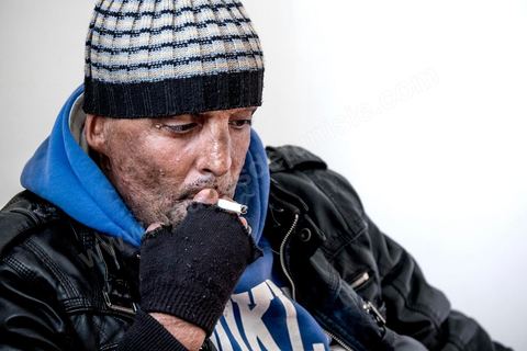 29 janvier 2016: Hosni Kaliya s'est immolé le 6 janvier 2011 après avroi été battu à deux reprises par des policiers de Kasserine. Cinq ans après, Hosni, brulé sur tout le corps doit vivre au quotidien avec des douleurs permanentes et le regard difficil de la société. Il vit actuellement dans un foyer social de l'Etat en attente d'être envoyé en Italie pour subir plusieurs interventions et poses de prothèses. Il y adeux mois son jeune frère s'est immolé à Kasserine et est décédé. l'immolation est devenu un phénoméne fréquent en Tunisie, en partie en mimétisme avec Mohamed Bouazizi, mais surtout comme un geste de desespoir d'une société et d'une jeunesse abandonnée (113 immolations en 2015).