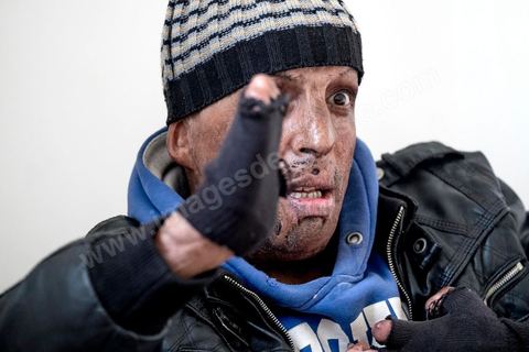 29 janvier 2016: Hosni Kaliya s'est immolé le 6 janvier 2011 après avroi été battu à deux reprises par des policiers de Kasserine. Cinq ans après, Hosni, brulé sur tout le corps doit vivre au quotidien avec des douleurs permanentes et le regard difficil de la société. Il vit actuellement dans un foyer social de l'Etat en attente d'être envoyé en Italie pour subir plusieurs interventions et poses de prothèses. Il y adeux mois son jeune frère s'est immolé à Kasserine et est décédé. l'immolation est devenu un phénoméne fréquent en Tunisie, en partie en mimétisme avec Mohamed Bouazizi, mais surtout comme un geste de desespoir d'une société et d'une jeunesse abandonnée (113 immolations en 2015).