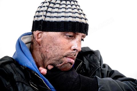 29 janvier 2016: Hosni Kaliya s'est immolé le 6 janvier 2011 après avroi été battu à deux reprises par des policiers de Kasserine. Cinq ans après, Hosni, brulé sur tout le corps doit vivre au quotidien avec des douleurs permanentes et le regard difficil de la société. Il vit actuellement dans un foyer social de l'Etat en attente d'être envoyé en Italie pour subir plusieurs interventions et poses de prothèses. Il y adeux mois son jeune frère s'est immolé à Kasserine et est décédé. l'immolation est devenu un phénoméne fréquent en Tunisie, en partie en mimétisme avec Mohamed Bouazizi, mais surtout comme un geste de desespoir d'une société et d'une jeunesse abandonnée (113 immolations en 2015).