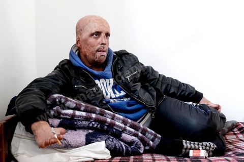 29 janvier 2016: Hosni Kaliya s'est immolé le 6 janvier 2011 après avroi été battu à deux reprises par des policiers de Kasserine. Cinq ans après, Hosni, brulé sur tout le corps doit vivre au quotidien avec des douleurs permanentes et le regard difficil de la société. Il vit actuellement dans un foyer social de l'Etat en attente d'être envoyé en Italie pour subir plusieurs interventions et poses de prothèses. Il y adeux mois son jeune frère s'est immolé à Kasserine et est décédé. l'immolation est devenu un phénoméne fréquent en Tunisie, en partie en mimétisme avec Mohamed Bouazizi, mais surtout comme un geste de desespoir d'une société et d'une jeunesse abandonnée (113 immolations en 2015).