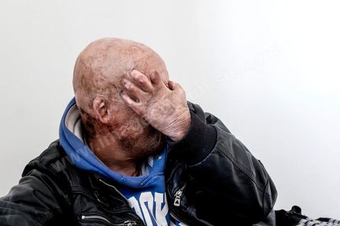 29 janvier 2016: Hosni Kaliya s'est immolé le 6 janvier 2011 après avroi été battu à deux reprises par des policiers de Kasserine. Cinq ans après, Hosni, brulé sur tout le corps doit vivre au quotidien avec des douleurs permanentes et le regard difficil de la société. Il vit actuellement dans un foyer social de l'Etat en attente d'être envoyé en Italie pour subir plusieurs interventions et poses de prothèses. Il y adeux mois son jeune frère s'est immolé à Kasserine et est décédé. l'immolation est devenu un phénoméne fréquent en Tunisie, en partie en mimétisme avec Mohamed Bouazizi, mais surtout comme un geste de desespoir d'une société et d'une jeunesse abandonnée (113 immolations en 2015).
