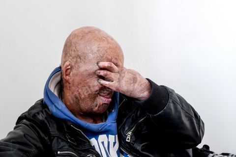 29 janvier 2016: Hosni Kaliya s'est immolé le 6 janvier 2011 après avroi été battu à deux reprises par des policiers de Kasserine. Cinq ans après, Hosni, brulé sur tout le corps doit vivre au quotidien avec des douleurs permanentes et le regard difficil de la société. Il vit actuellement dans un foyer social de l'Etat en attente d'être envoyé en Italie pour subir plusieurs interventions et poses de prothèses. Il y adeux mois son jeune frère s'est immolé à Kasserine et est décédé. l'immolation est devenu un phénoméne fréquent en Tunisie, en partie en mimétisme avec Mohamed Bouazizi, mais surtout comme un geste de desespoir d'une société et d'une jeunesse abandonnée (113 immolations en 2015).