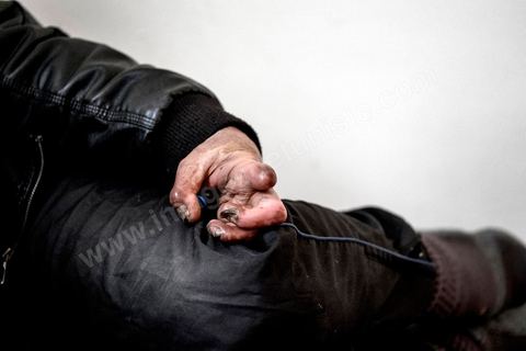29 janvier 2016: Hosni Kaliya s'est immolé le 6 janvier 2011 après avroi été battu à deux reprises par des policiers de Kasserine. Cinq ans après, Hosni, brulé sur tout le corps doit vivre au quotidien avec des douleurs permanentes et le regard difficil de la société. Il vit actuellement dans un foyer social de l'Etat en attente d'être envoyé en Italie pour subir plusieurs interventions et poses de prothèses. Il y adeux mois son jeune frère s'est immolé à Kasserine et est décédé. l'immolation est devenu un phénoméne fréquent en Tunisie, en partie en mimétisme avec Mohamed Bouazizi, mais surtout comme un geste de desespoir d'une société et d'une jeunesse abandonnée (113 immolations en 2015).
