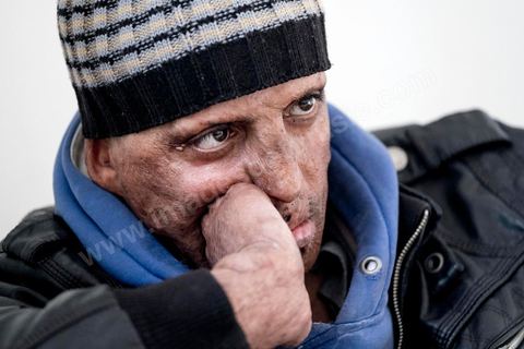 29 janvier 2016: Hosni Kaliya s'est immolé le 6 janvier 2011 après avroi été battu à deux reprises par des policiers de Kasserine. Cinq ans après, Hosni, brulé sur tout le corps doit vivre au quotidien avec des douleurs permanentes et le regard difficil de la société. Il vit actuellement dans un foyer social de l'Etat en attente d'être envoyé en Italie pour subir plusieurs interventions et poses de prothèses. Il y adeux mois son jeune frère s'est immolé à Kasserine et est décédé. l'immolation est devenu un phénoméne fréquent en Tunisie, en partie en mimétisme avec Mohamed Bouazizi, mais surtout comme un geste de desespoir d'une société et d'une jeunesse abandonnée (113 immolations en 2015).