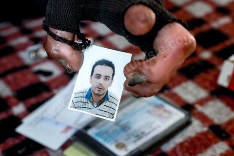 29 janvier 2016: Hosni Kaliya s'est immolé le 6 janvier 2011 après avroi été battu à deux reprises par des policiers de Kasserine. Cinq ans après, Hosni, brulé sur tout le corps doit vivre au quotidien avec des douleurs permanentes et le regard difficil de la société. Il vit actuellement dans un foyer social de l'Etat en attente d'être envoyé en Italie pour subir plusieurs interventions et poses de prothèses. Il y adeux mois son jeune frère s'est immolé à Kasserine et est décédé. l'immolation est devenu un phénoméne fréquent en Tunisie, en partie en mimétisme avec Mohamed Bouazizi, mais surtout comme un geste de desespoir d'une société et d'une jeunesse abandonnée (113 immolations en 2015).