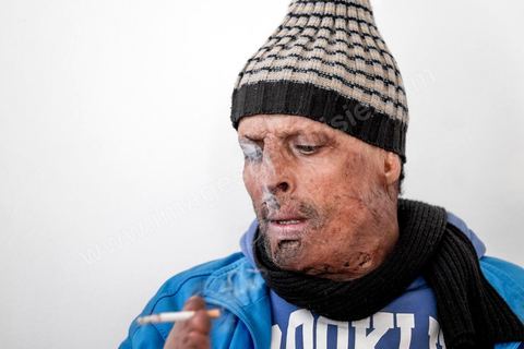 24 février 2016: Hosni Kaliya s'est immolé le 6 janvier 2011 après avroi été battu à deux reprises par des policiers de Kasserine. Cinq ans après, Hosni, brulé sur tout le corps doit vivre au quotidien avec des douleurs permanentes et le regard difficil de la société. Il vit actuellement dans un foyer social de l'Etat en attente d'être envoyé en Italie pour subir plusieurs interventions et poses de prothèses. Il y adeux mois son jeune frère s'est immolé à Kasserine et est décédé. l'immolation est devenu un phénoméne fréquent en Tunisie, en partie en mimétisme avec Mohamed Bouazizi, mais surtout comme un geste de desespoir d'une société et d'une jeunesse abandonnée (113 immolations en 2015).