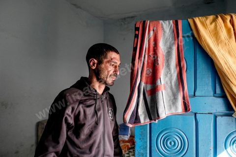 25 février 2016 : Baligh Aloui, 33 ans, s'est immolé le jeudi 21 janvier devant sa maison familiale où il vit avec ses parents, frères et soeur. C'est son frère, Abdelsattar, qui l'a sauvé en se jetant sur lui. Il est brulé au visage et mains au second degrès. Il s'est immolé ce jeudi 21 janvier, au lendemain de l'annonce de la création de 5000 emplois à Kasserine par le gouvernement. Ce jour là, les chômeurs se sont précipités au gouvernorat, aux délégations et aux municipalités pour s'inscrire dans un nouvel espoir d'avoir enfin un travail, une activité stable, un revenu digne, ... cet afflux a créé un désordre, un débordement, des tensions, ... ce jeune se voyant une nouvelle fois rejeté par l'administration, par l'état, est rentré chez lui avec une bouteille d'essence et s'est immolé dans la rue devant sa maison, devant sa mère, ses frères et soeurs. C'est à son frère qu'il doit sa survie, il a pu très vite l'éteindre, mais ce jeune est marqué à vie, brulé au second degrés sur l'ensemble du visage dans l'indifférence totale de la société et du gouvernement, en 2015 113 personnes se sont immolés en Tunisie.