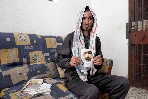 25 février 2016 : Baligh Aloui, 33 ans, s'est immolé le jeudi 21 janvier devant sa maison familiale où il vit avec ses parents, frères et soeur. C'est son frère, Abdelsattar, qui l'a sauvé en se jetant sur lui. Il est brulé au visage et mains au second degrès. Il s'est immolé ce jeudi 21 janvier, au lendemain de l'annonce de la création de 5000 emplois à Kasserine par le gouvernement. Ce jour là, les chômeurs se sont précipités au gouvernorat, aux délégations et aux municipalités pour s'inscrire dans un nouvel espoir d'avoir enfin un travail, une activité stable, un revenu digne, ... cet afflux a créé un désordre, un débordement, des tensions, ... ce jeune se voyant une nouvelle fois rejeté par l'administration, par l'état, est rentré chez lui avec une bouteille d'essence et s'est immolé dans la rue devant sa maison, devant sa mère, ses frères et soeurs. C'est à son frère qu'il doit sa survie, il a pu très vite l'éteindre, mais ce jeune est marqué à vie, brulé au second degrés sur l'ensemble du visage dans l'indifférence totale de la société et du gouvernement, en 2015 113 personnes se sont immolés en Tunisie.