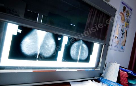 Service gratuit de mamographie au Centre de Recherche en Santé de la Repproduction de l'Ariana à Tunis - Office national de la Famille et de la Population - Ministère de la Santé Publique